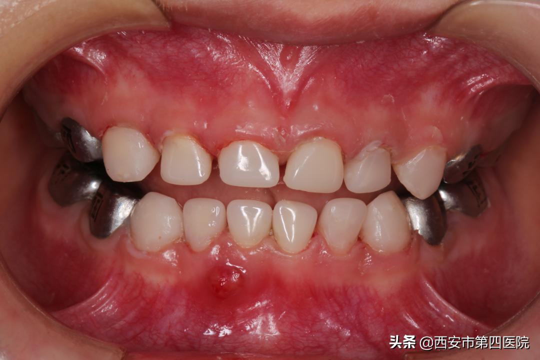 健康中国儿童青少年健康行动方案,6岁孩子大牙龋齿要不要处理