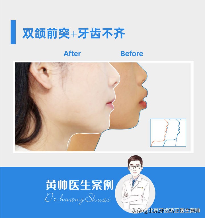 嘴凸的人怎么笑起来好看,嘴凸怎么让自己不焦虑