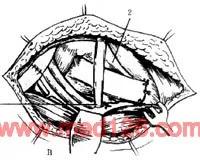 扁平足发病机制,扁平足诊断标准示意图