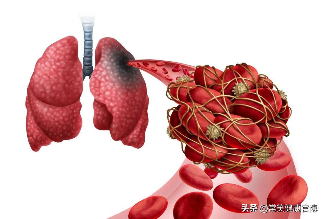 突然咯血别慌专家带你找真凶,咯血死亡是怎么回事