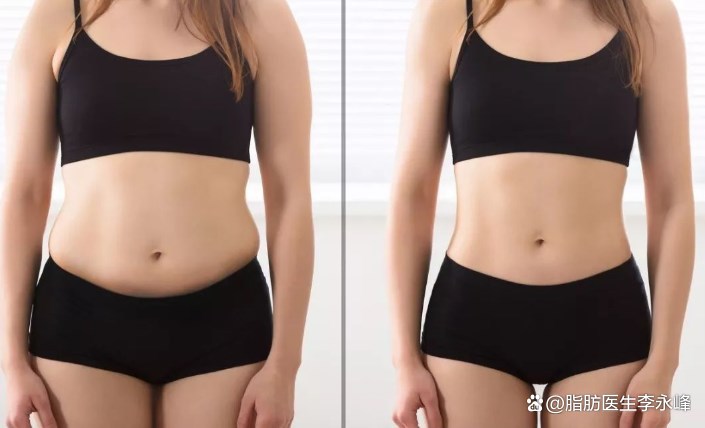 吸脂后皮肤会松弛下垂吗,腹部吸脂后怎么解决皮肤松弛