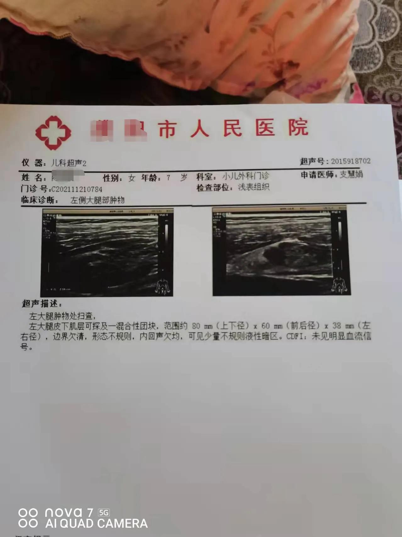 下肢血肿中医怎么治疗,小儿面部血肿消除最快方法