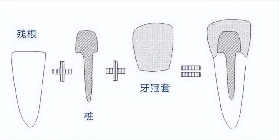牙齿断了一半怎么处理最好多少钱,牙齿断了一半怕冰怎么处理最好