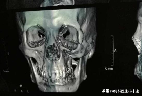 韩德君掌骨骨折多久痊愈了,韩德君鼻骨骨折为什么