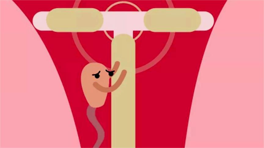 节育环在女性体内，会发生哪些变化？30年前上环的女性有哪些结局