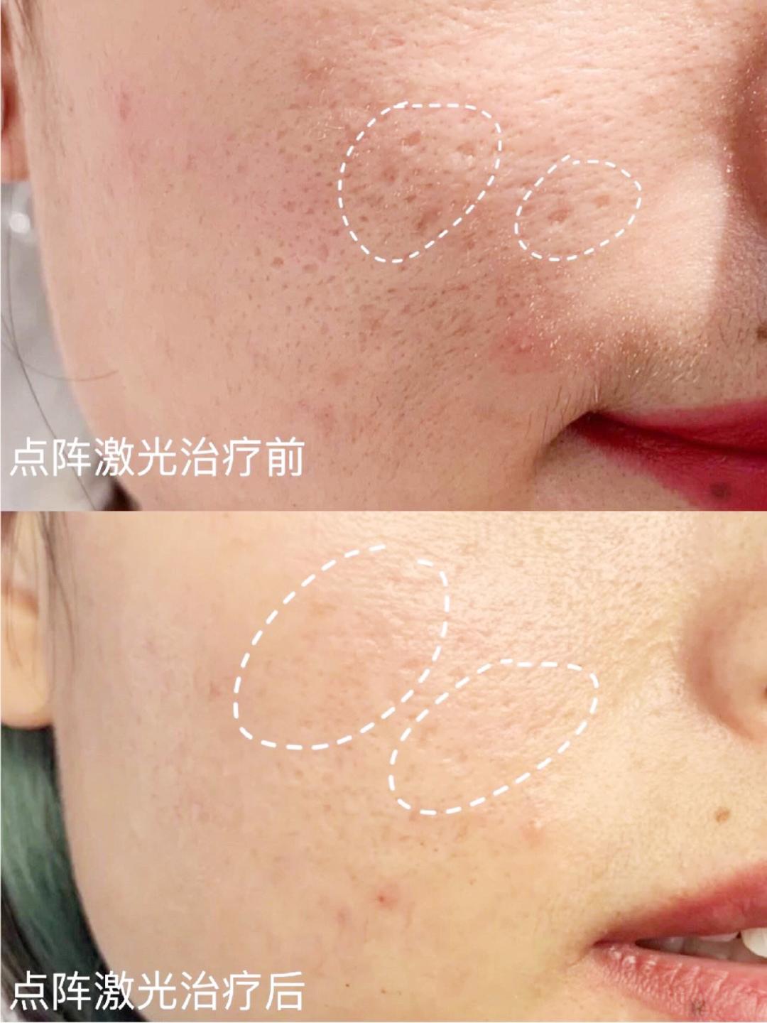 缩毛孔最简单方法,缩毛孔的方法亲身经历