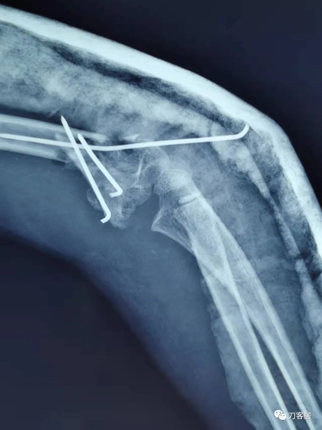 孩子胳膊摔伤肿了不能弯曲一直疼,9岁男孩摔倒手臂痛怎么办