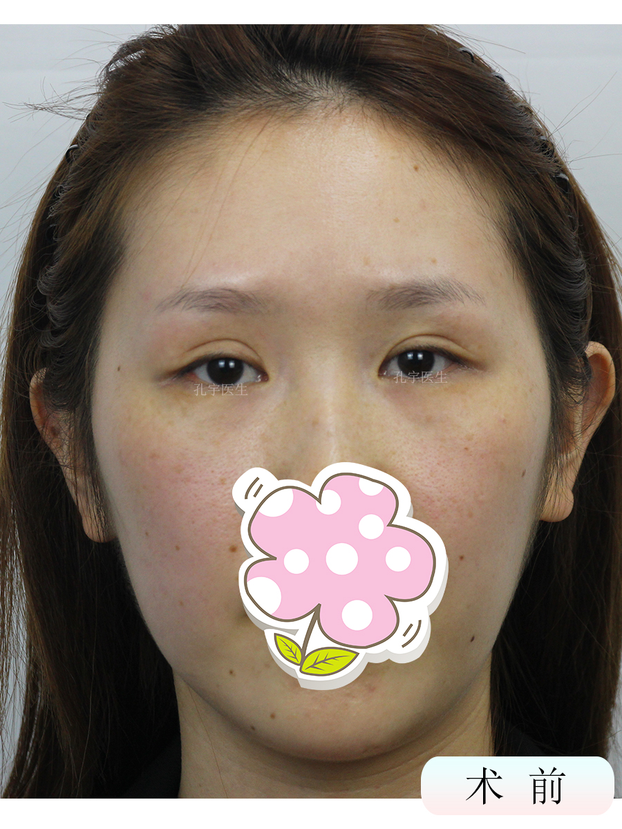 我做了双眼皮下眼睑会肿怎么回事,做了双眼皮十天肉条感严重怎么办