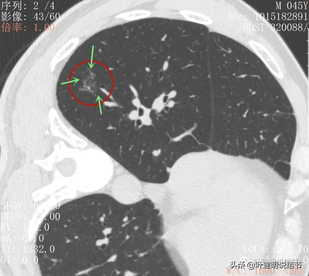 肺蜂窝状改变是肺癌吗,肺部陈旧灶与肿瘤怎么确诊