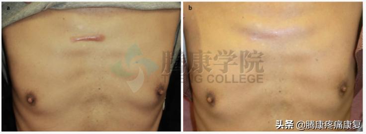 皮质类固醇贴剂治疗瘢痕疙瘩,类固醇激素治疗疤痕增生
