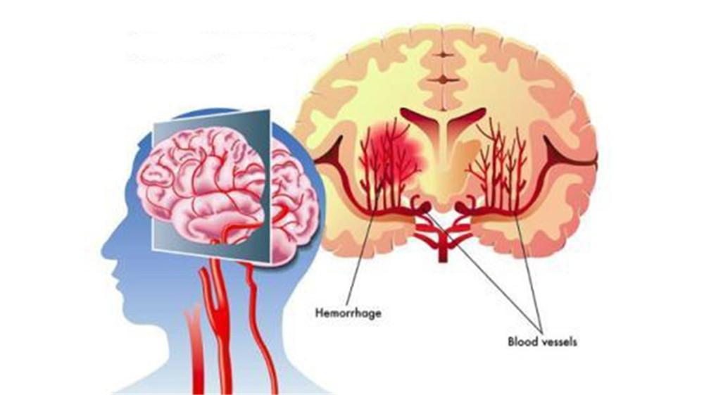 家里老人脑出血应该怎样安慰,家人脑出血自己如何调整心情