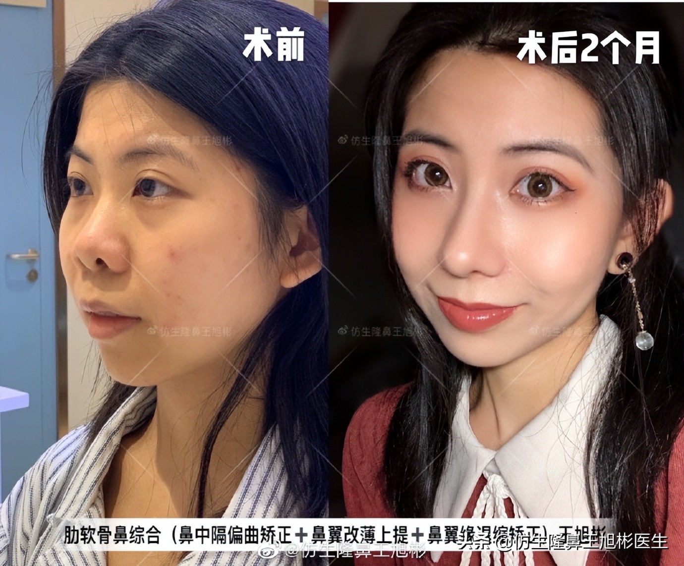 可以只做鼻头不放假体吗,只做鼻头鼻翼缩小手术多少钱