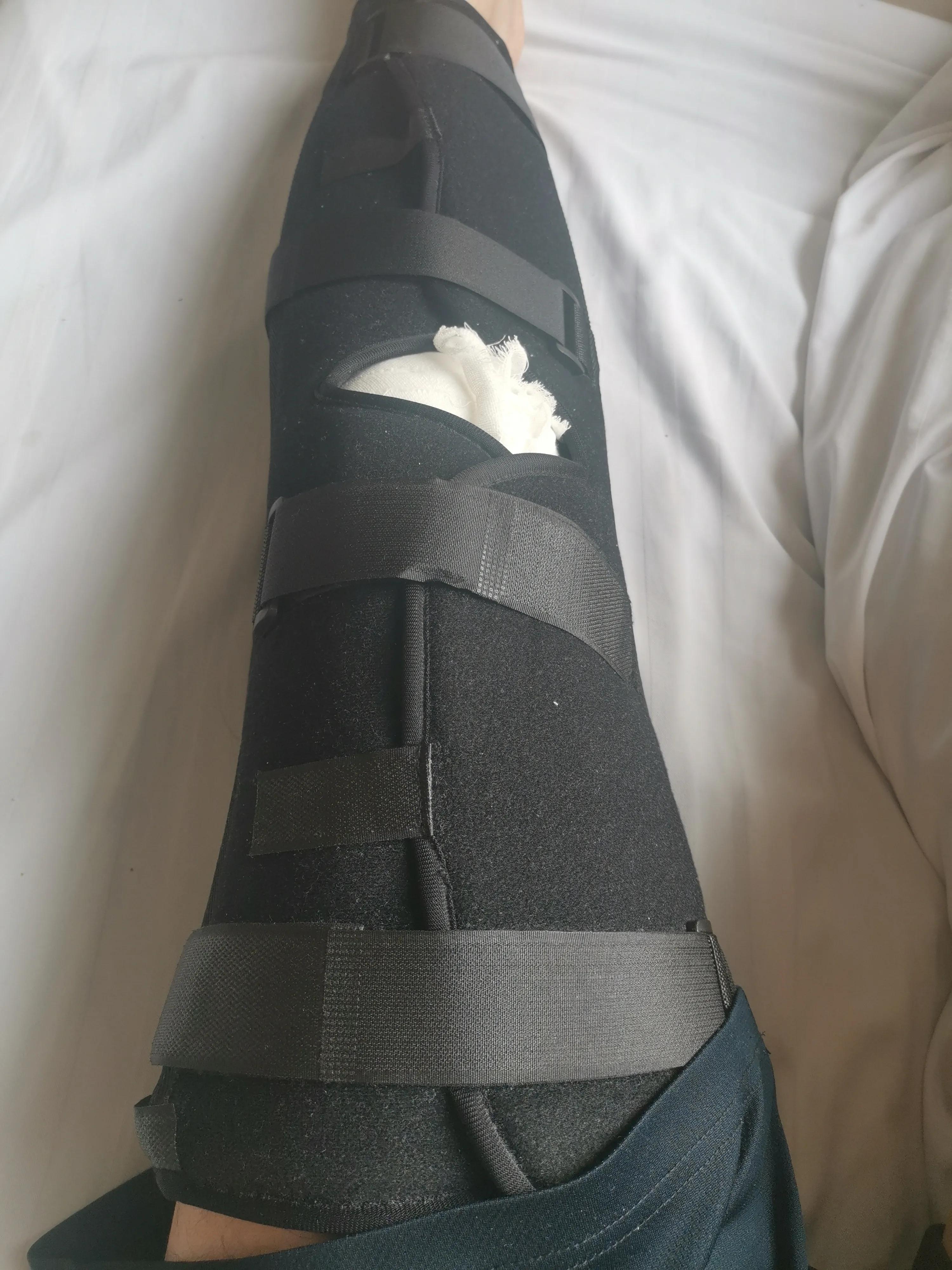 后角半月板撕裂微创手术,半月板撕裂微创手术沈阳