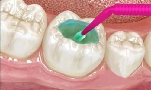 广州哪家医院看牙比较实惠,广州三甲医院种牙齿多少钱一颗