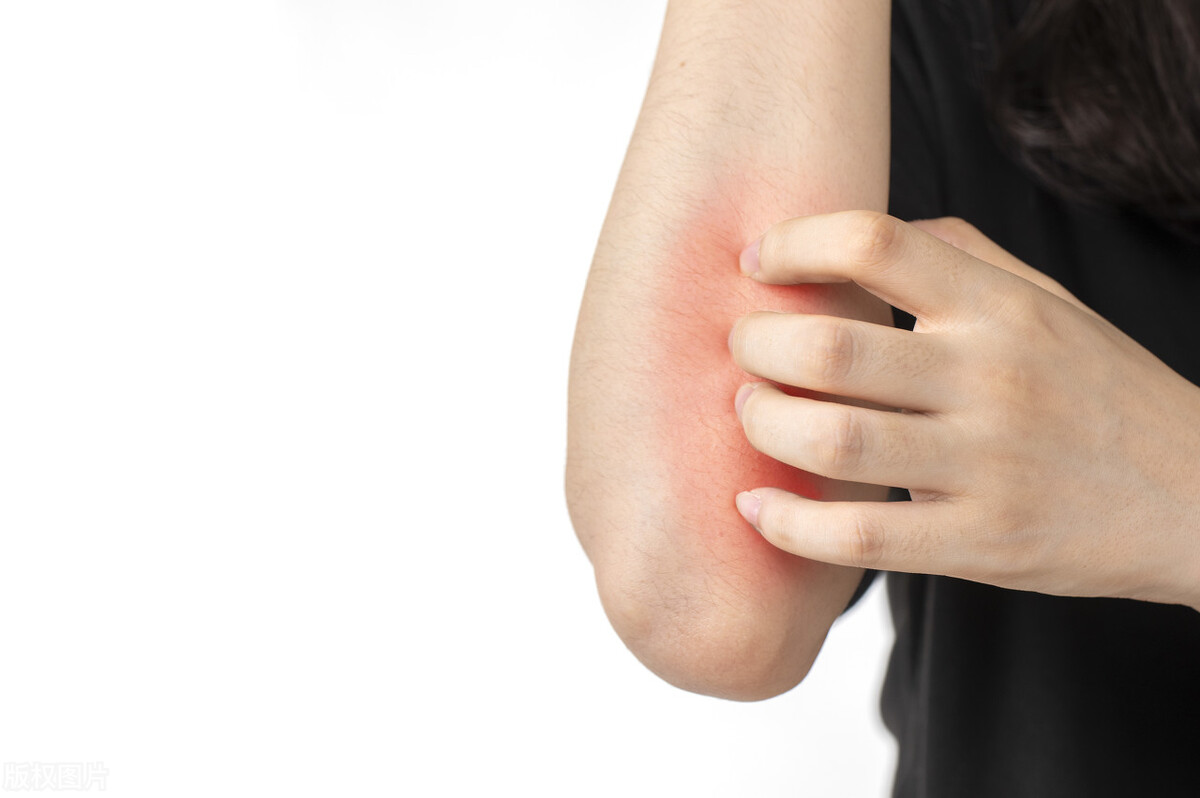 湿疹荨麻疹最有效的抗过敏药,皮炎湿疹荨麻疹都是什么皮肤病