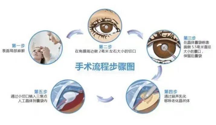 年纪大了看不清能戴老花镜吗,年纪大了看不见眼睛