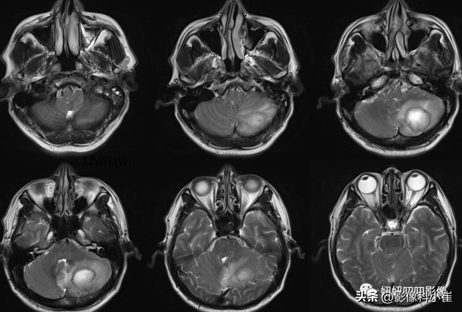 脑部局灶性强化是什么意思,脑部环形强化灶是什么意思