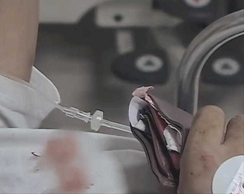 80岁老人尿毒症放弃治疗,80后小伙尿毒症晚期已移植