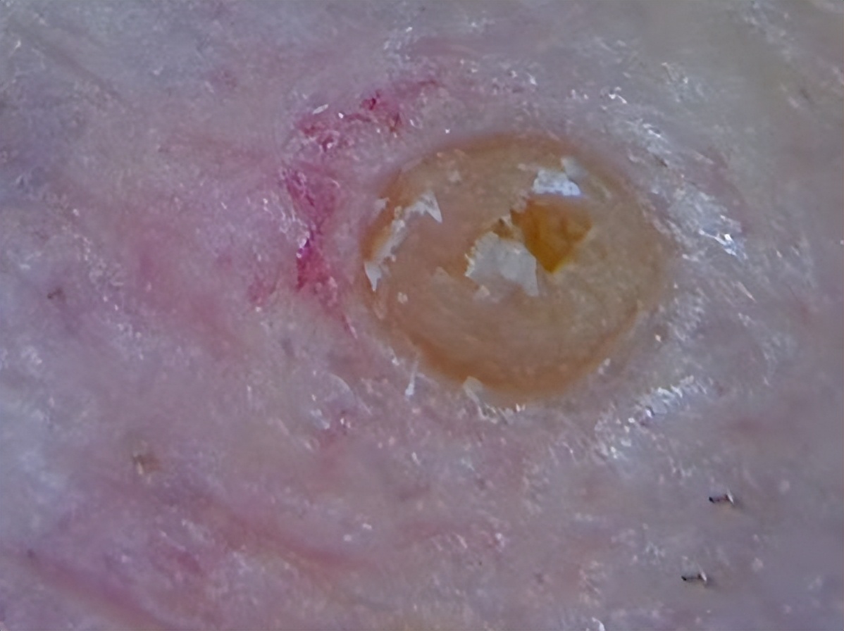 真黑头怎么去,黑头用黑头膏为什么去不掉黑头