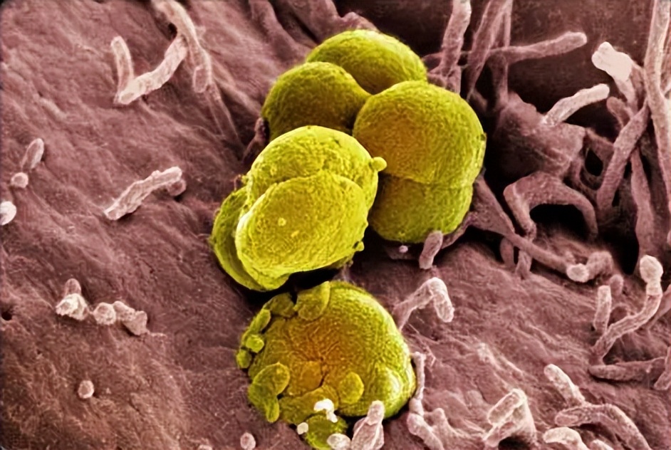 用酒店毛巾后被确诊淋病,广西男子患上淋病