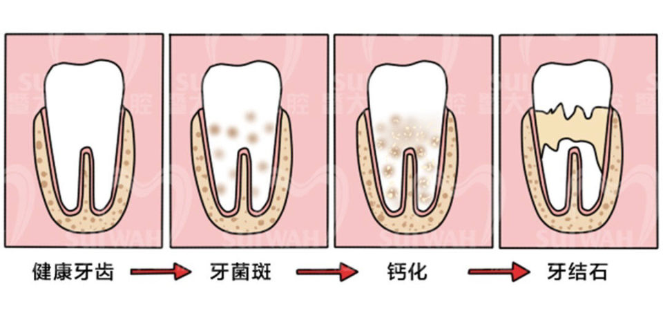 很久没刷牙有牙斑怎么去除,牙齿长了小黑点能靠刷牙解决吗