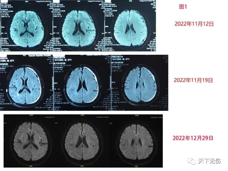 慢性硬膜下血肿临床诊疗指南,慢性硬膜下血肿120例临床分析