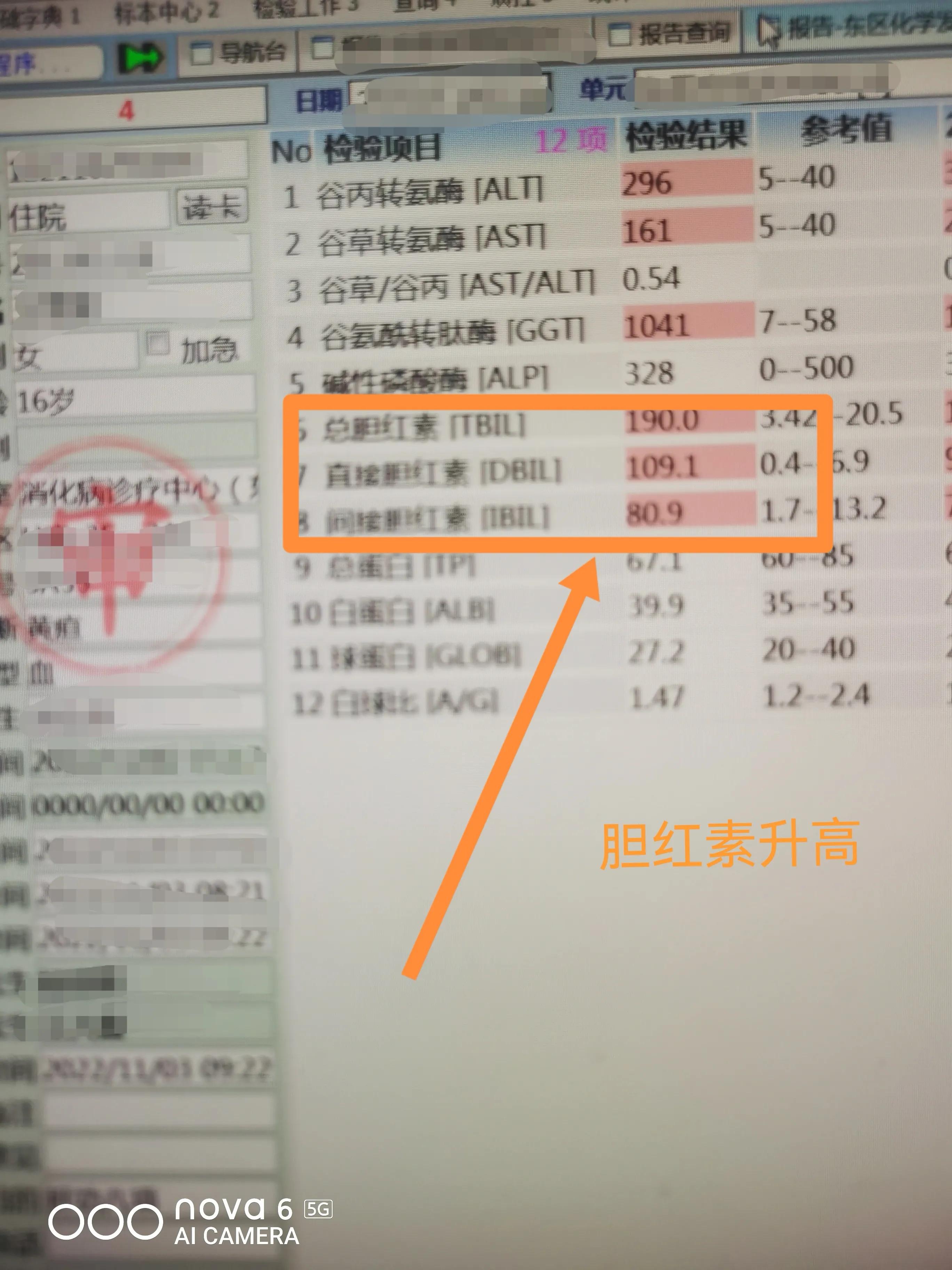 上火会导致尿液发黄吗,小便发黄是体内有火吗