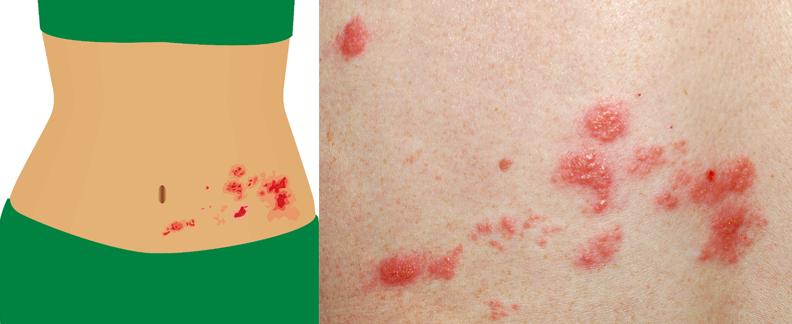 皮肤病忌口什么发物,发物会加重皮肤病吗