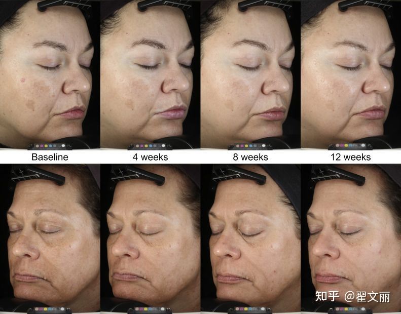 小编给大家推荐几款有效祛斑精华,公认最好最实惠美白祛斑精华