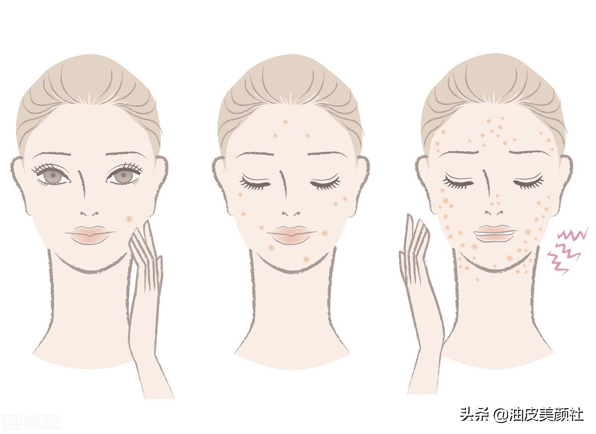 祛痘好物推荐一下,推荐十款实用的祛痘产品