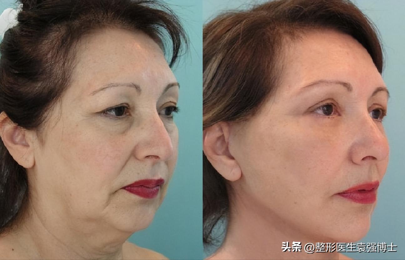 拉皮手术后的真实面部对比,拉皮手术真的会让人看起来年轻吗