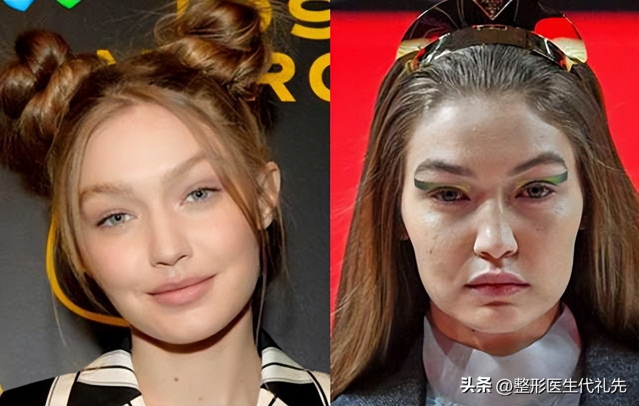 脸颊凹陷怎么改善最有效的方法,面颊衰老凹陷怎么改善