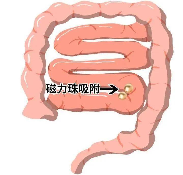 男孩往尿道塞近200颗“玩具球”，喜欢塞东西的熊孩子怎么回事