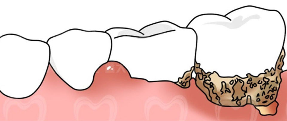 牙疼怎么辨别是哪种牙病,牙疼怎么判断是上火还是有炎症