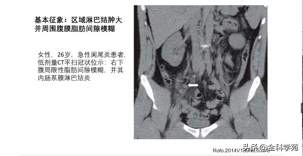 阑尾炎的讲解,关于阑尾炎的讨论总结