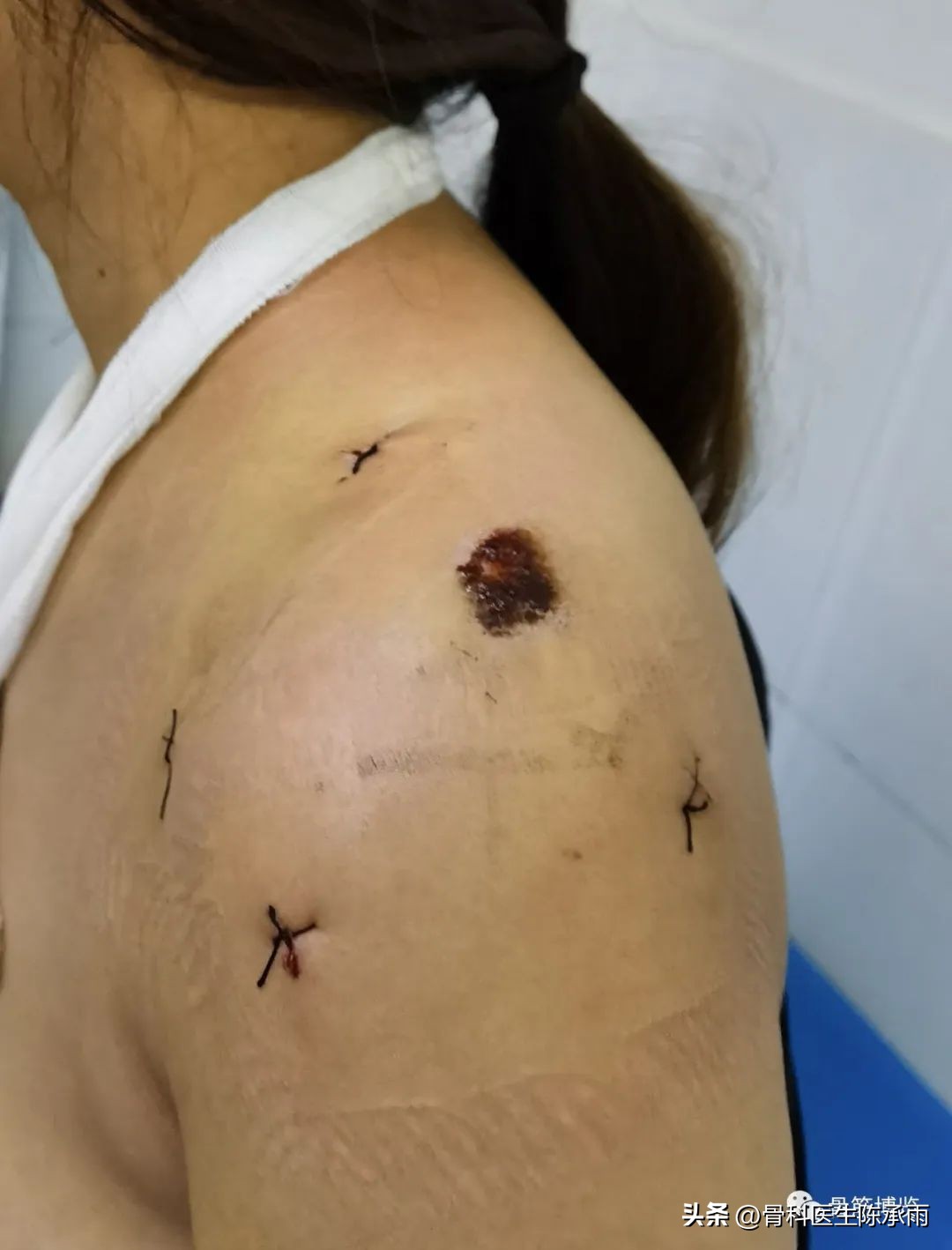 锁骨骨折保守治疗肩关节康复训练,肩锁骨远端骨折保守治疗要多久