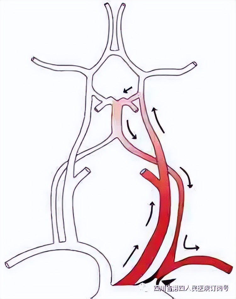 我院首例！左锁骨下动脉支架成形术取得成功，患者已得到改善