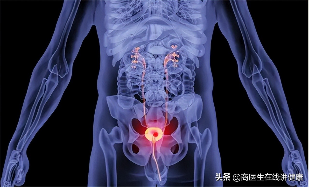 降血糖的特效药达格列净,糖尿病降糖药达格列净