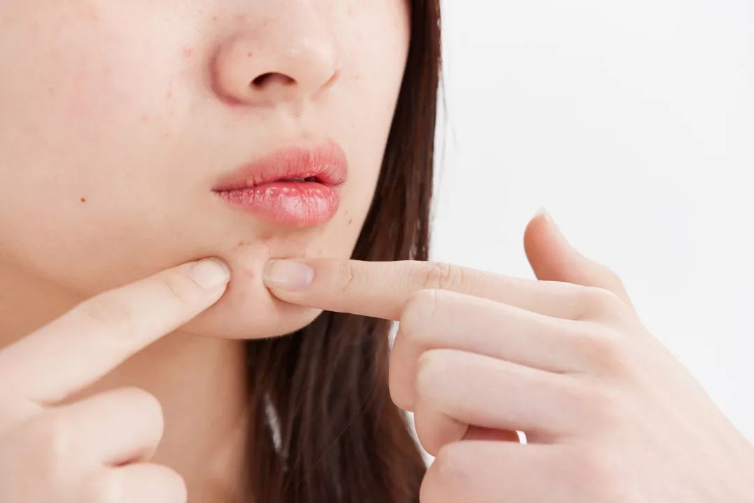 还在为你脸上的痘痘而烦恼吗,你有没有痘痘困扰