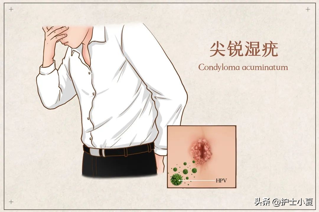 治疗hpv感染用干扰素注意事项,感染hpv后十大禁忌男性注意什么