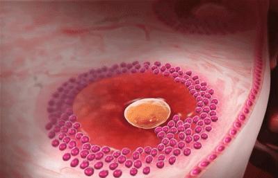 跳毽子操后引发卵巢黄体破裂,跳操会造成卵巢扭转吗