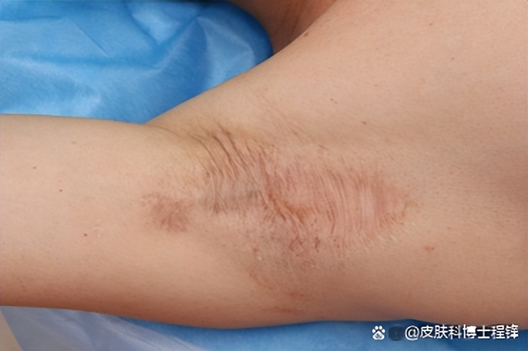 做完腋臭微创手术复发几率,腋臭手术后复发了怎么调理排毒