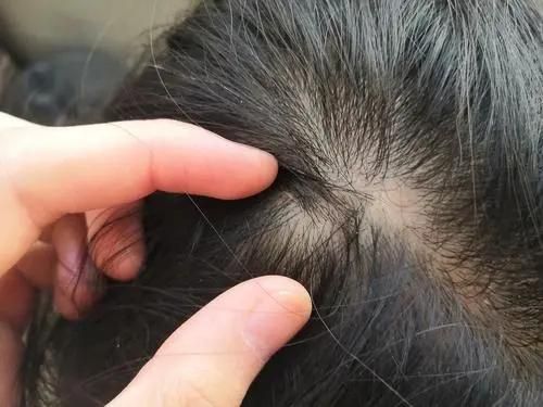 头皮上长红疙瘩脓包是什么原因,头皮经常起小脓包疙瘩很疼