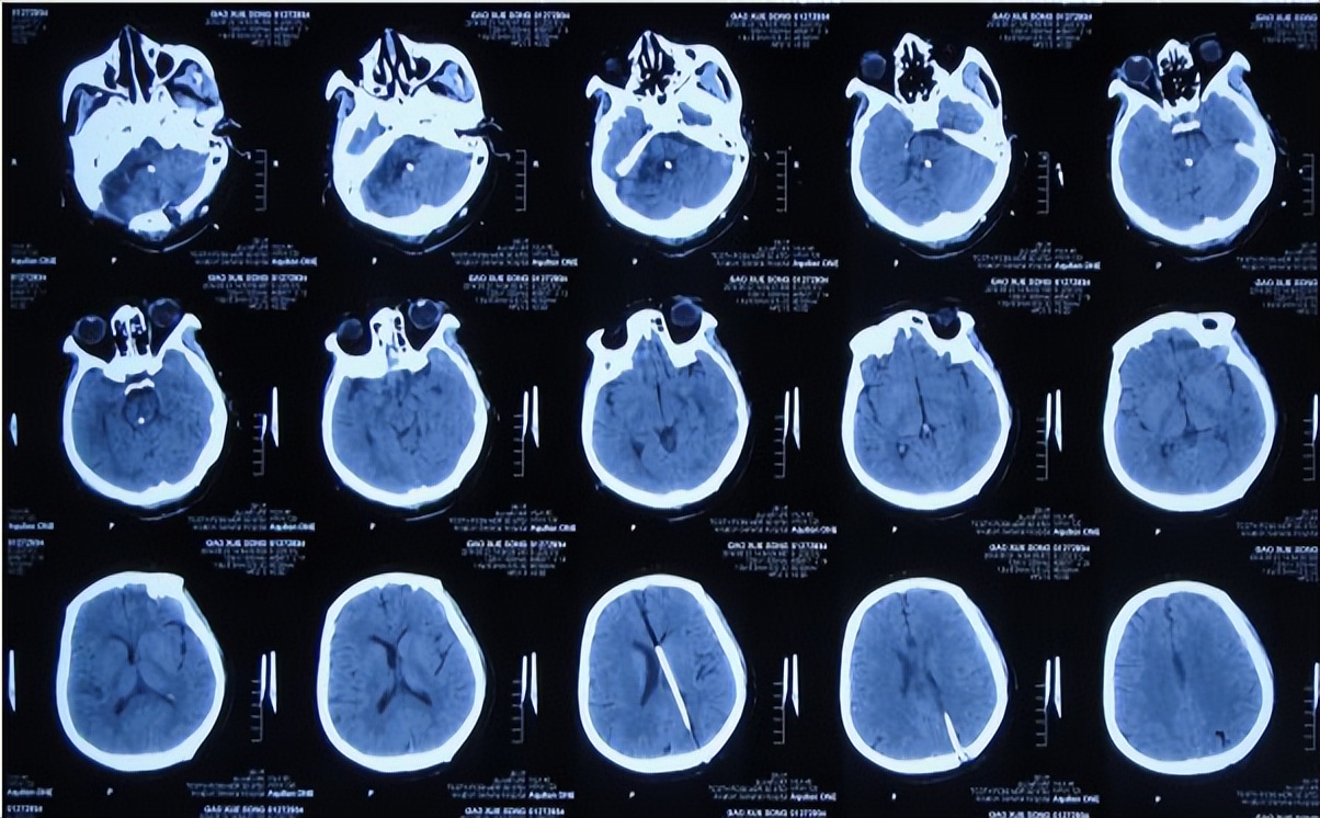 听神经瘤出现脑积水和出血,听神经瘤手术后颅压高症状