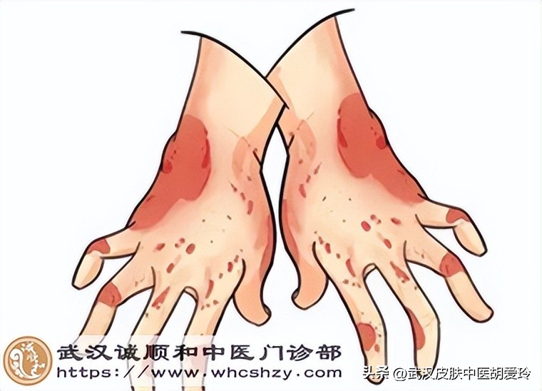 手指甲边缘肿痛并挤出脓,双手对称起小水泡很痒怎么回事