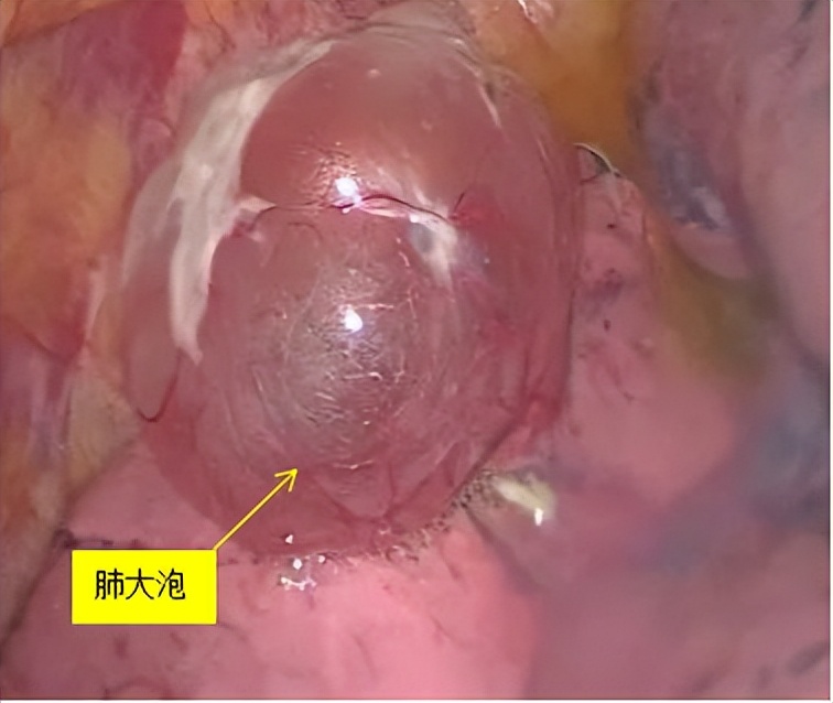 深呼吸右边肺漏气,感觉肺部漏气的感觉