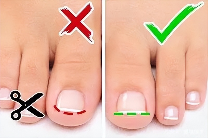 一走路脚趾甲痛,甲沟炎拔完脚趾甲很疼怎么办