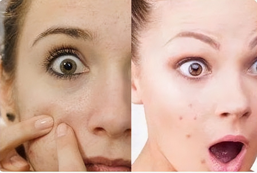 鼻子两侧的螨虫可以挤吗,鼻子里挤出的白色细条是螨虫吗