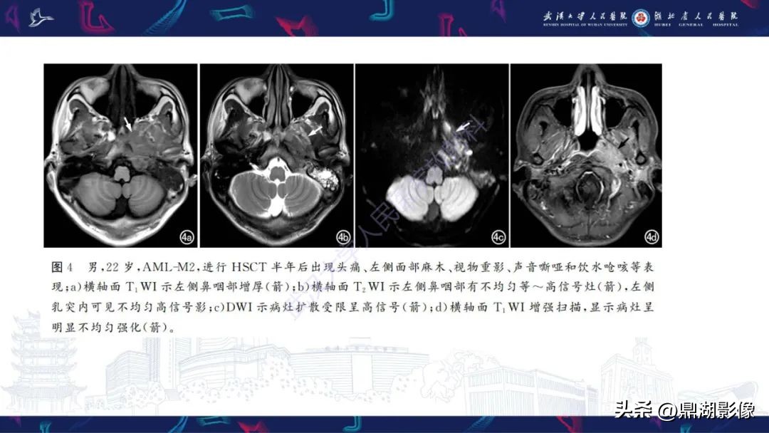 阴道肉瘤的早期症状,阴道里长肉瘤是啥症状