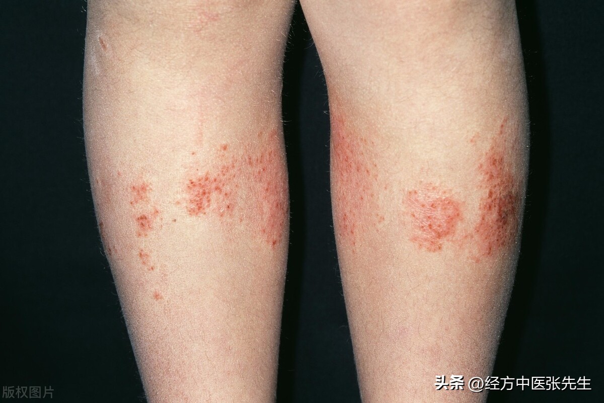 慢性湿疹一年多：中医调和营卫，健脾化积治愈